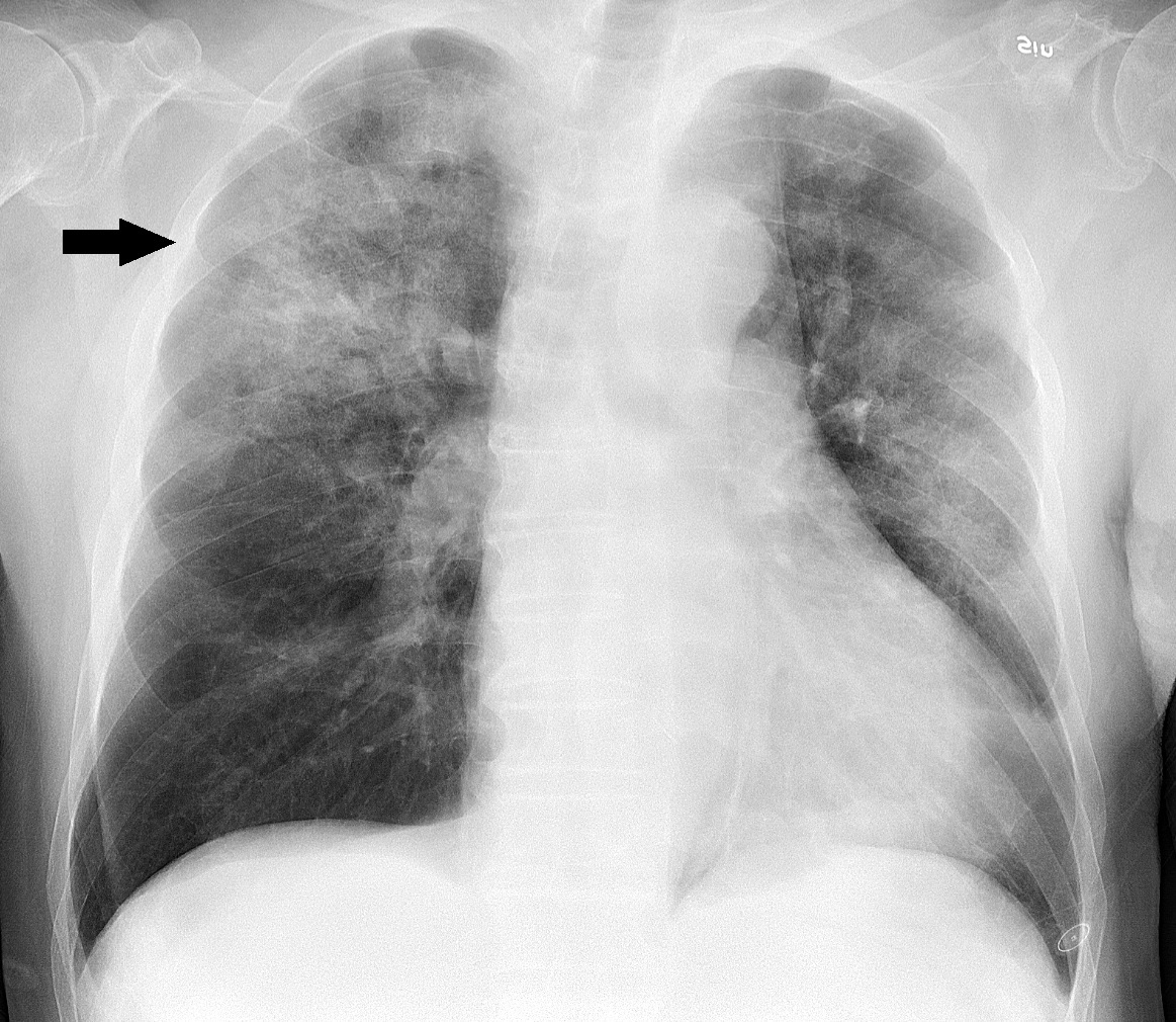 Пневмония правого легкого рентген