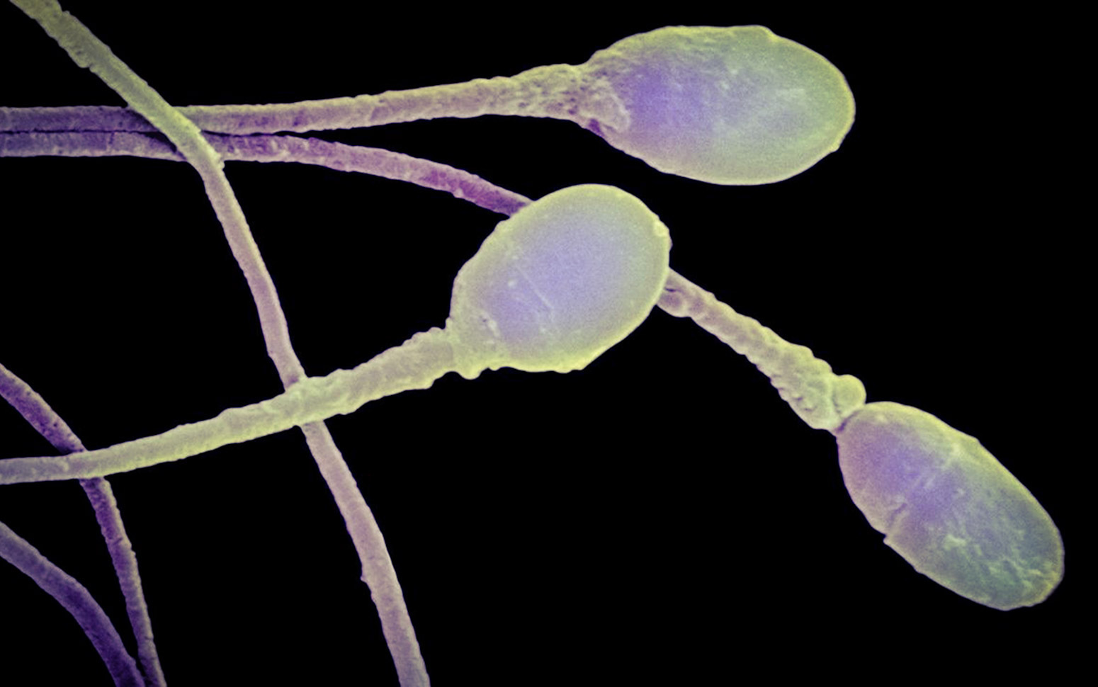 Управление мужской фертильностью: важность замораживания спермы