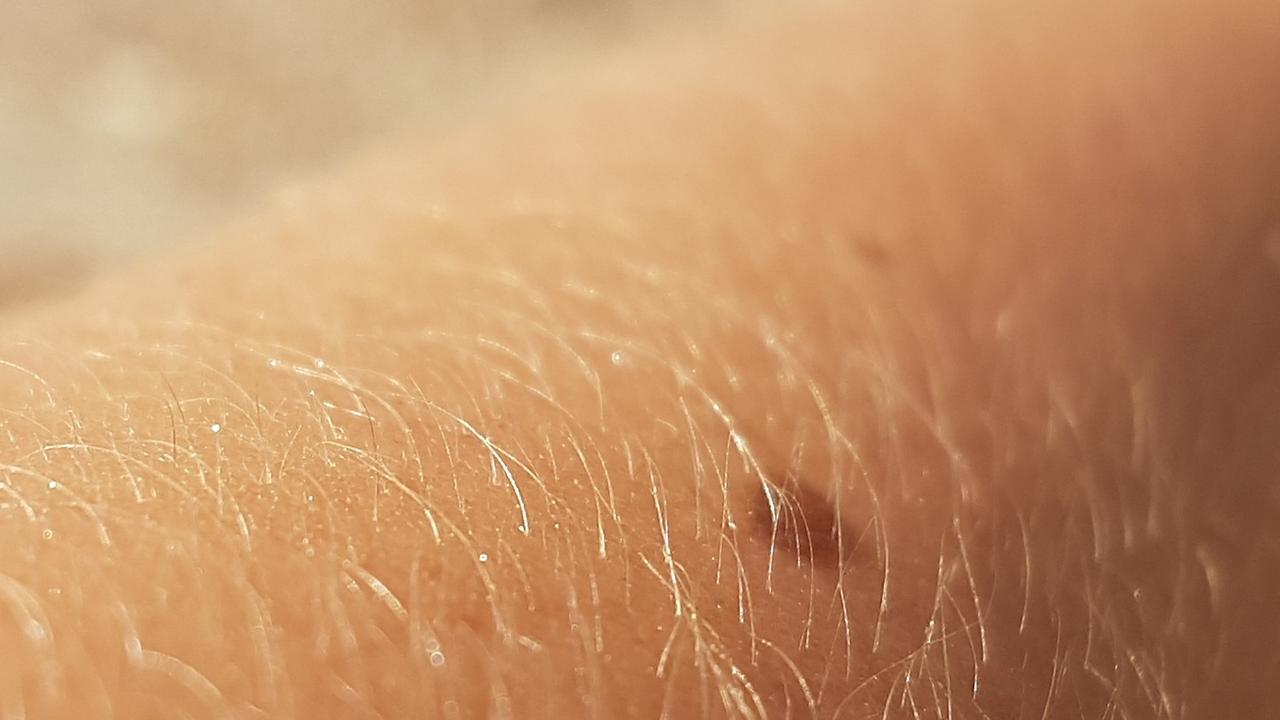 рак кожи фото начальная стадия симптомы