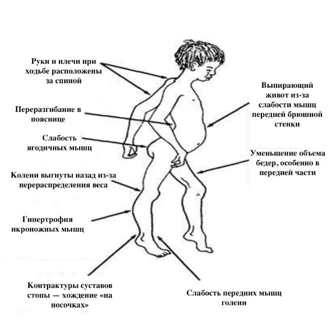 Ранние клинические проявления миодистрофии Дюшенна (DOI:10.5075/epfl-thesis-9104 с изм.)