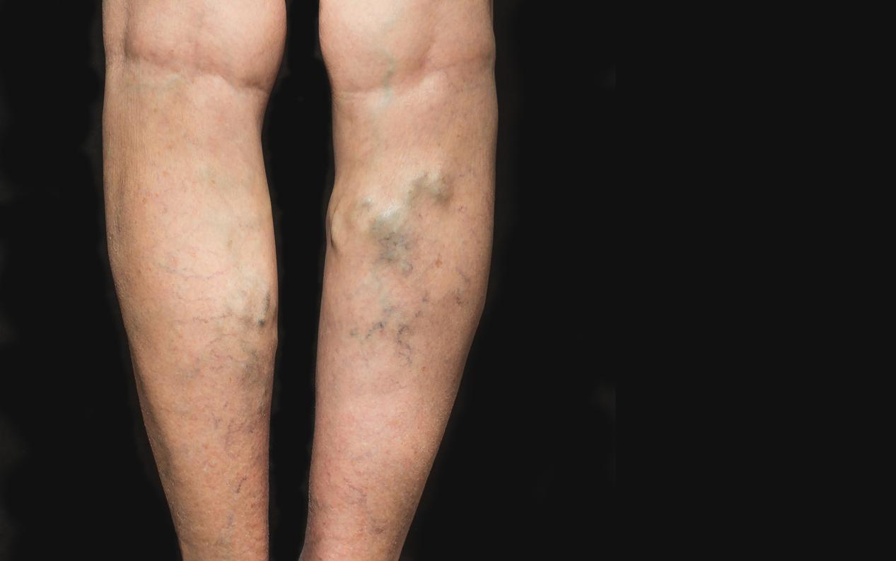 Варикозные узлы на ногах: статьи клиники Оксфорд Медикал Киев