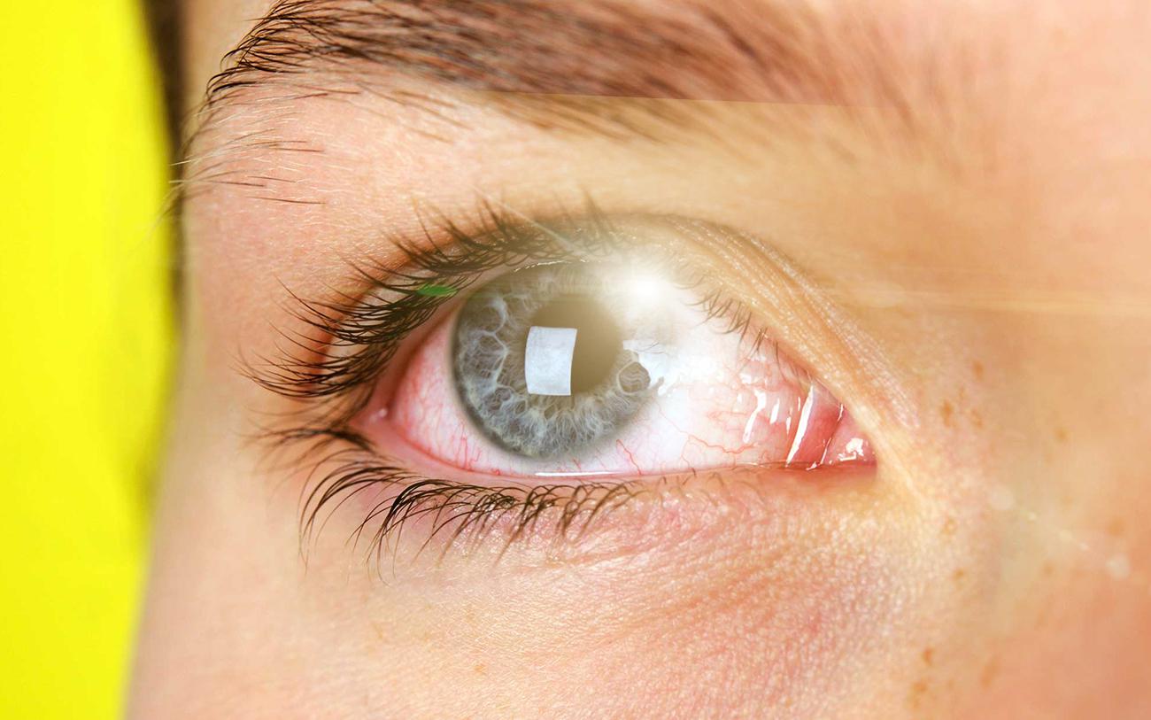 Синдром сухого глаза симптомы