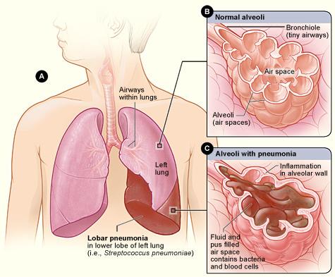 Воспаление легких: симптомы, лечение пневмонии у взрослых