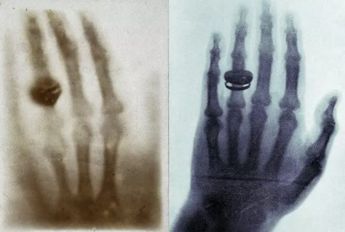 Слева - кисть жены Рентгена, самый первый рентгеновский снимок, справа - кисть Келликера