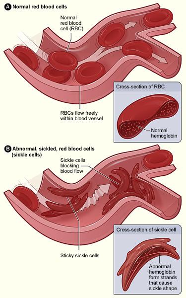 «Неправильный» гемоглобин при серповидноклеточной анемии приводит к деформации эритроцитов. Клетки теряют гибкость и застревают в капиллярах, приводя к образованию тромбов